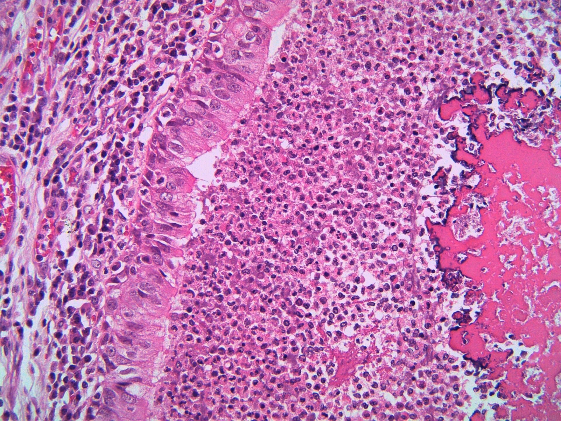 A lung bronchiole lined by ciliated epithelium and filled with massive acute inflammation and thickened mucus at right. Patient with Cystic fibrosis. Microscopic view. Biofilms Oral Health